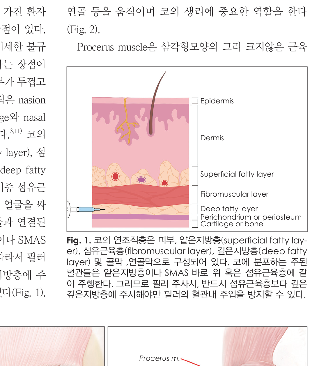 Fig.1 - 코 연조직 단면도 (7 layers)