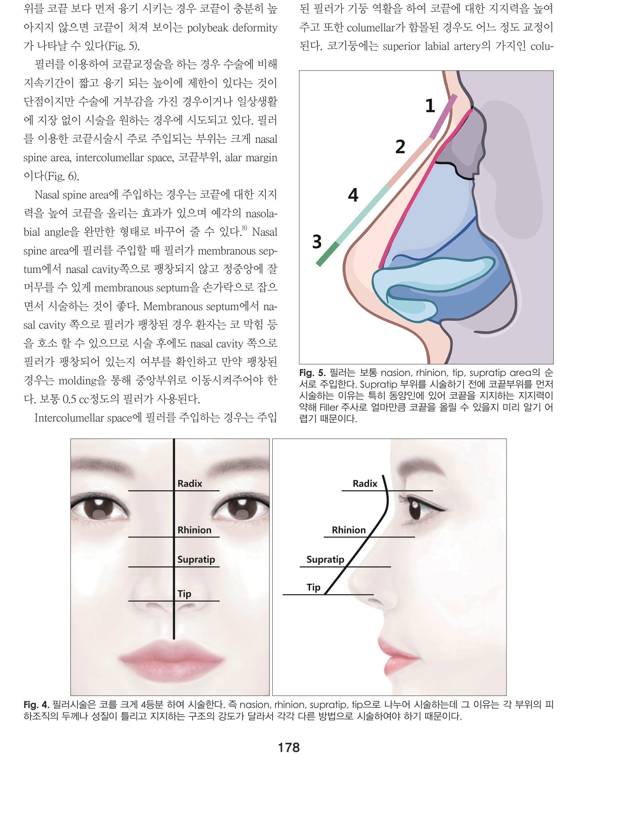 Fig.4+5 - 코 4등분 시술영역 + 주입순서